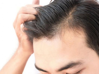 Caduta capelli: cause, sintomi e rimedi